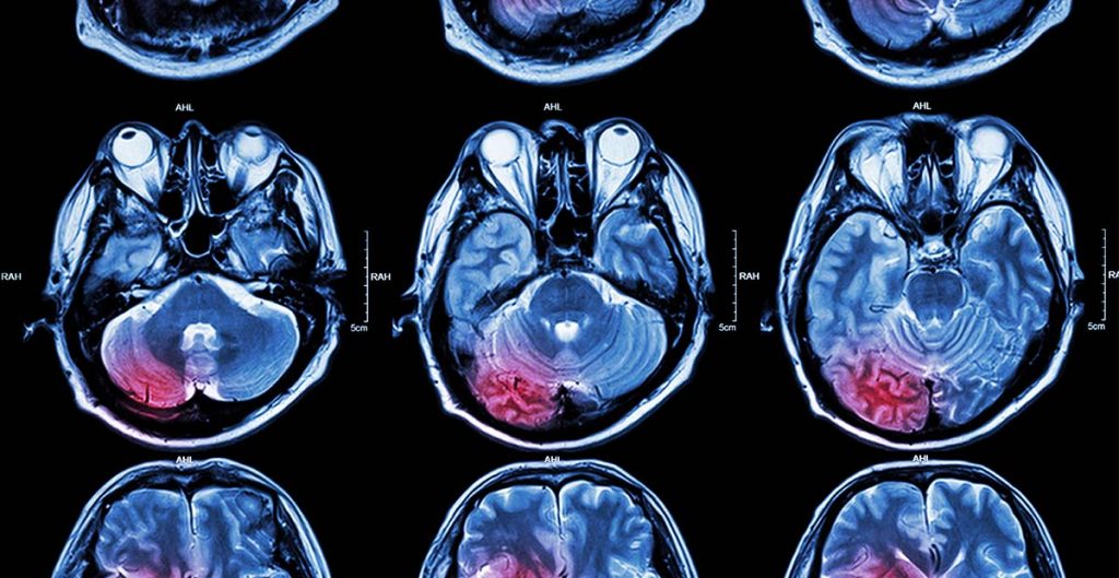 Cele mai periculoase tumori cerebrale