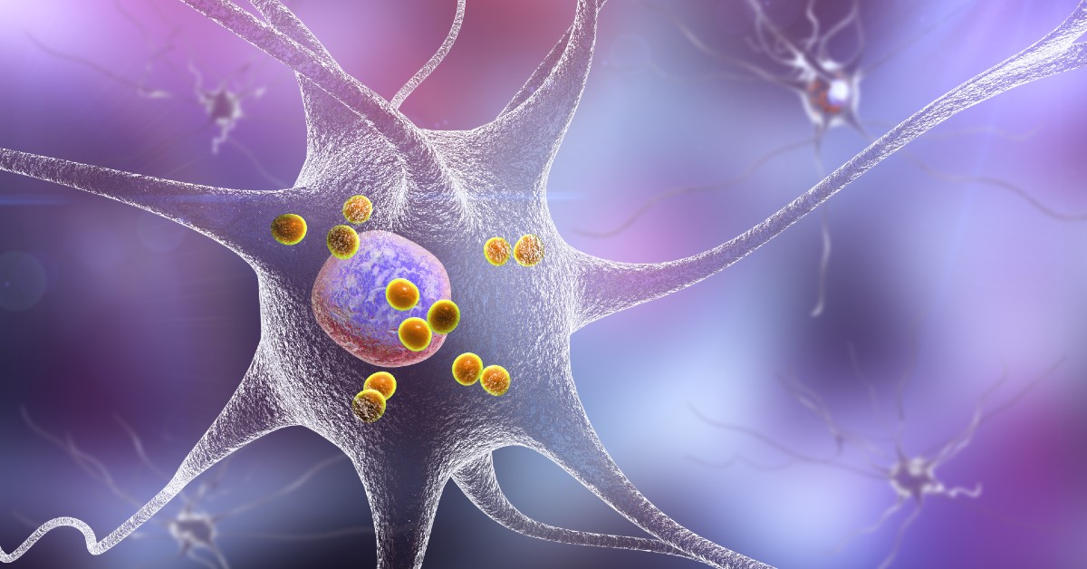 dementa-cu-corpi-lewy-neuron-3d