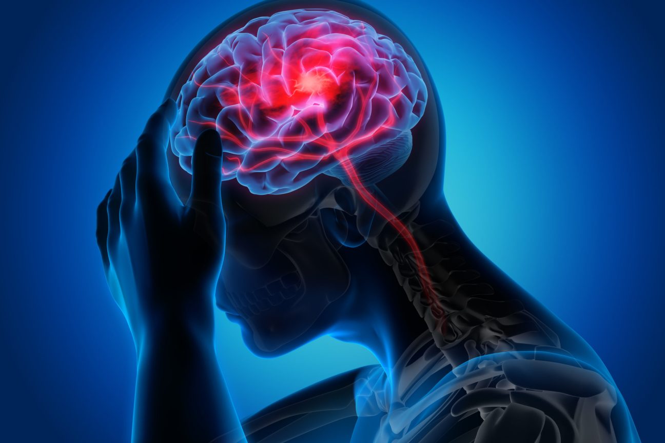 Accident vascular cerebral (AVC) ischemic si hemoragic