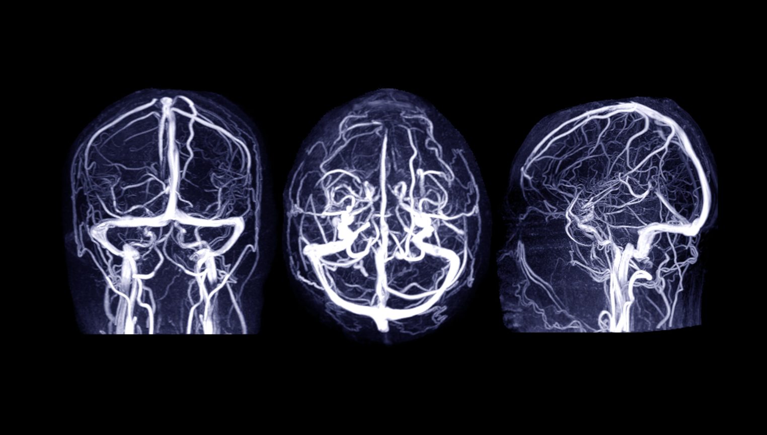 Afectiuni si tratamente T Tromboza venoasa cerebrala