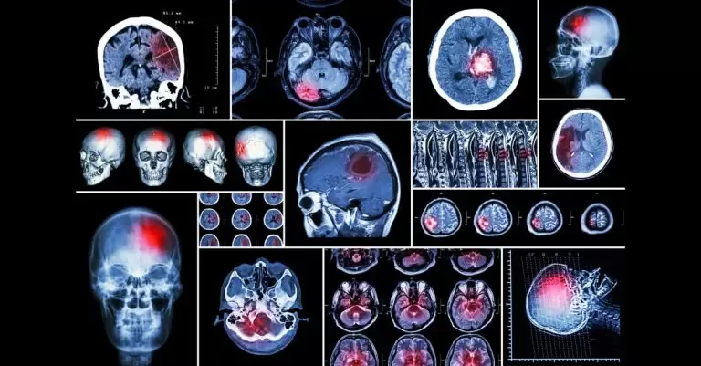 infarct medular
