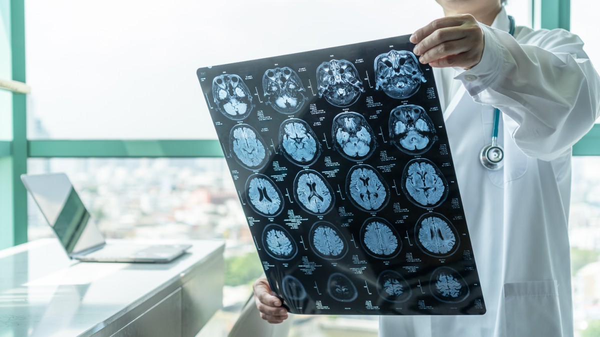 medic analizeaza RMN-ul cerebral al unui pacient