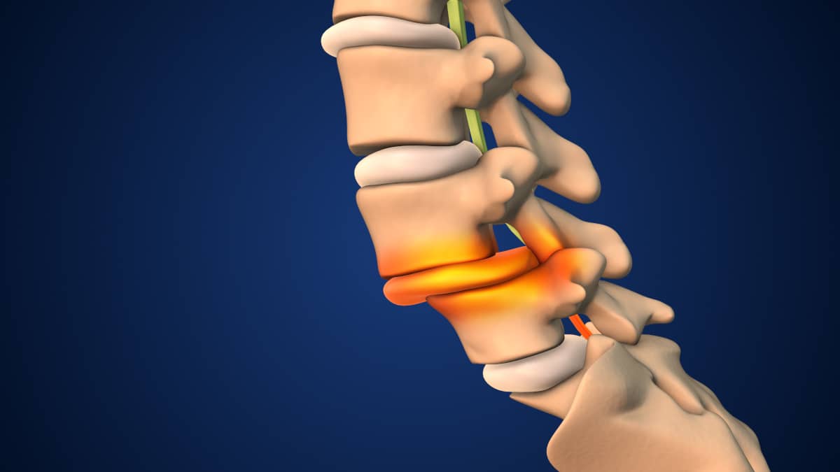 spondilolistezis sau vertebra delasata la nivel lombar