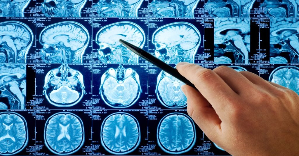 Ateroscleroza cerebrala – cauze, simptome si diagnostic