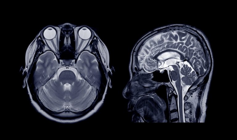 Rmn cerebral cu substanta de contrast, Neuroaxis
