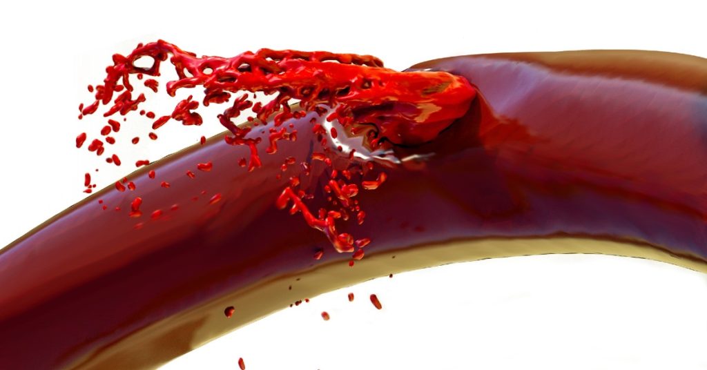 Cand si de ce se produce hemoragia cerebrala (avc hemoragic)?