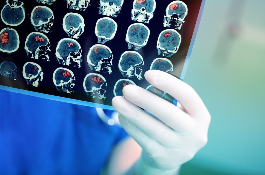 Analize pentru depistarea AVC. Cum este diagnosticat accidentul vascular cerebral